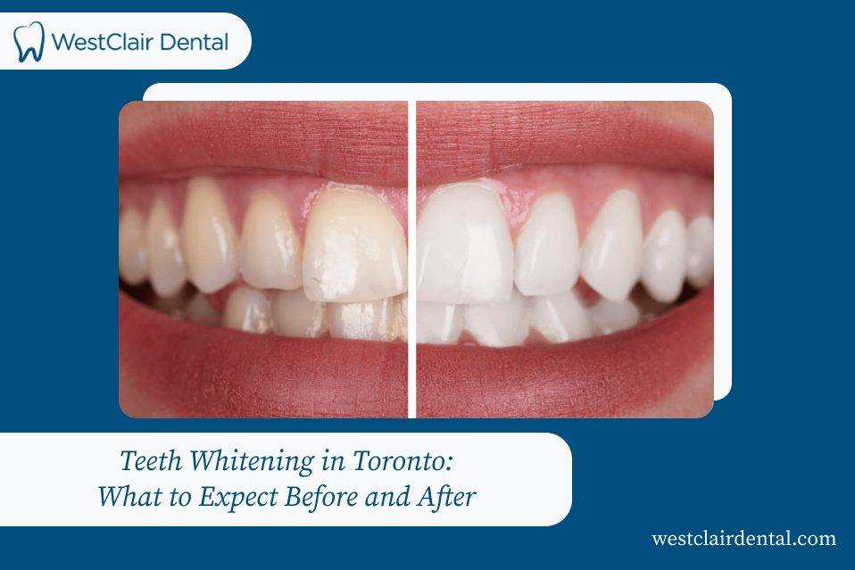 Teeth Whitening in Toronto: What to Expect Before and After
